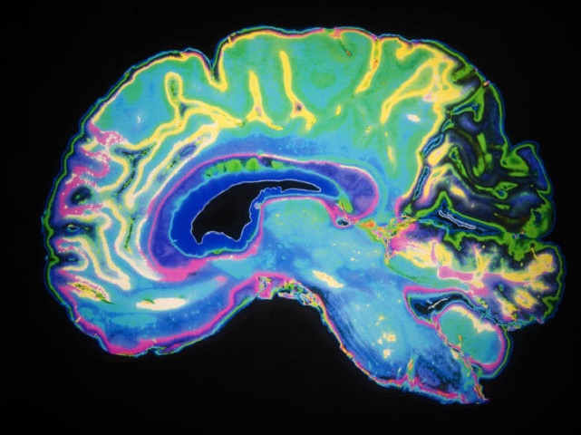 Új Alzheimer-kór gyógyszert hagytak jóvá Amerikában