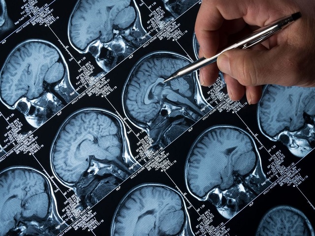 Áttörést jelentő kezelést fejlesztenek Alzheimer-kórra