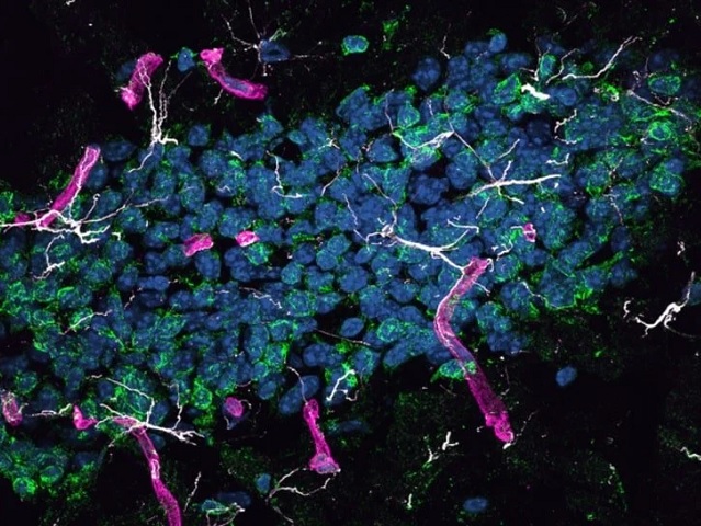 Megtalálhatták az Alzheimer-kór egyik fő okozóját