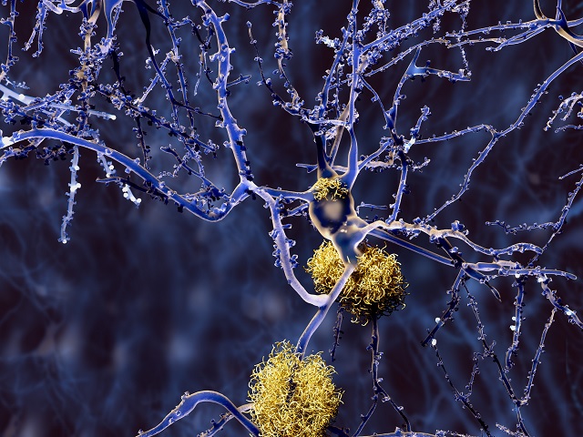 Még egy lépéssel közelebb az Alzheimerhez