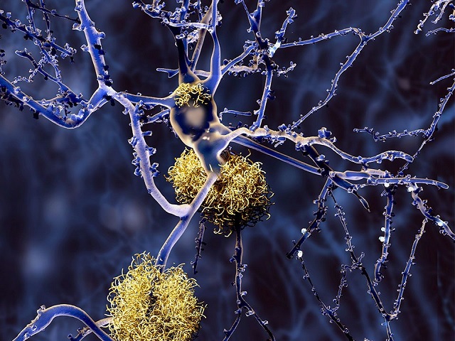Eddig sosem látott módon ismerhetjük meg az Alzheimert