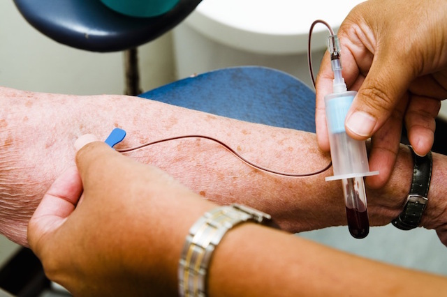 Egyszerű vérteszttel is kimutatható lesz az Alzheimer