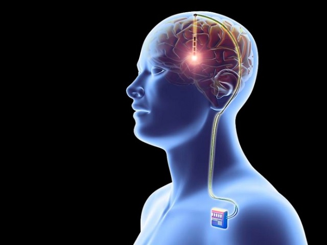 Új módszer az Alzheimer ellen